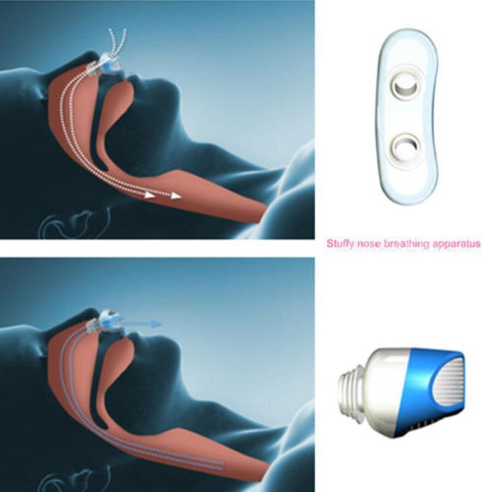 Anti-Snoring Device