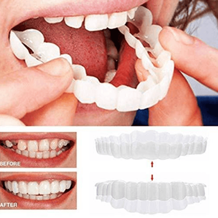 PerfectSmile™ Braces