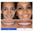 PerfectSmile™ Braces