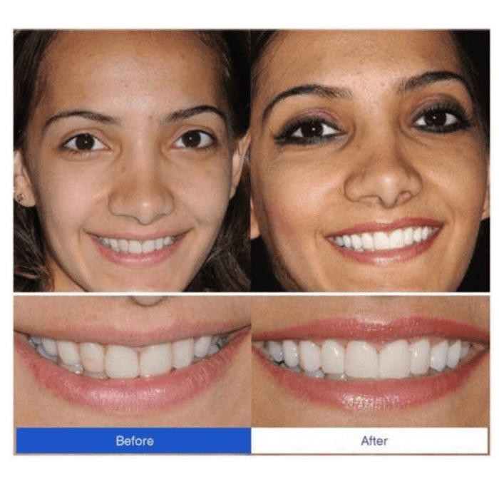 PerfectSmile™ Braces