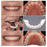 PerfectSmile™ Braces