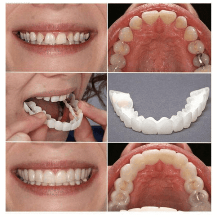 PerfectSmile™ Braces