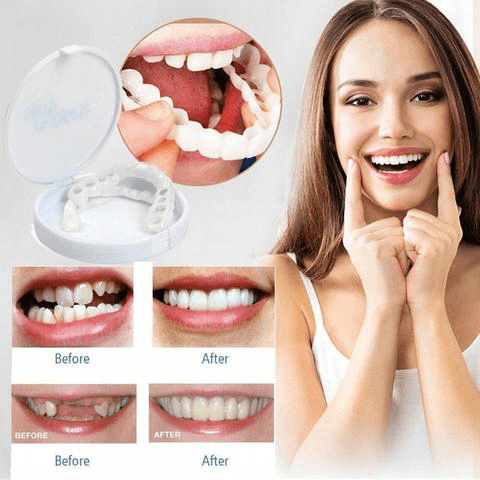 PerfectSmile™ Braces